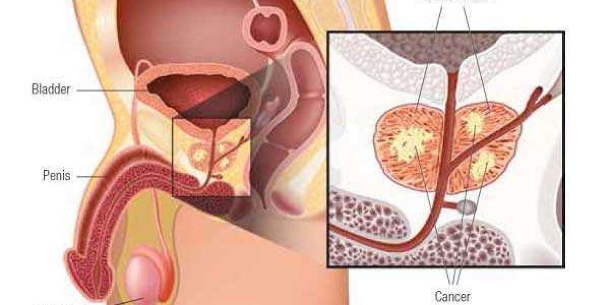 Understanding the Ineffectiveness of Prostate Cancer Screening